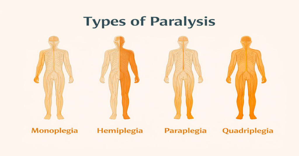 Types of paralysis illustration showing monoplegia, hemiplegia, paraplegia, and quadriplegia – explained for Virupakshipuram paralysis treatment patients